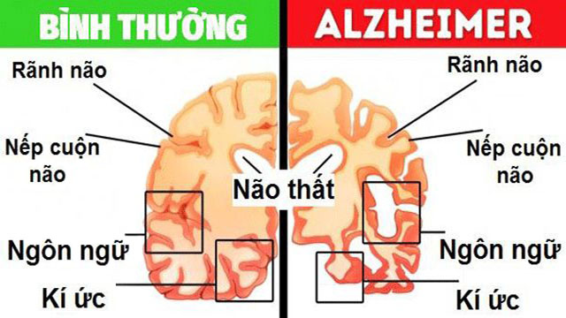 Bệnh Alzheimer là gì? Nguyên nhân, triệu chứng, cách điều trị và chăm sóc