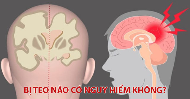 Bị teo não có nguy hiểm không? Có di truyền không?