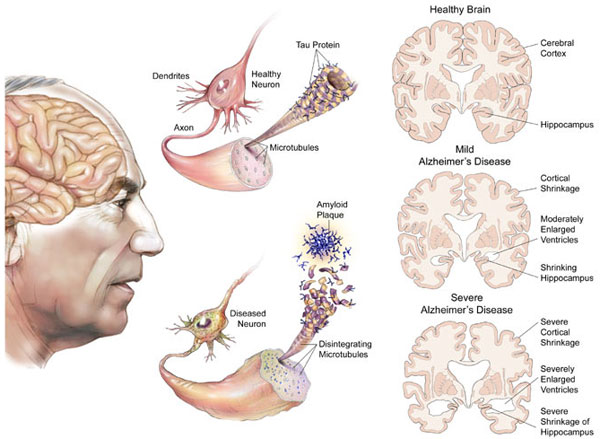 Bệnh alzheimer giai đoạn cuối| Triệu chứng và điều trị