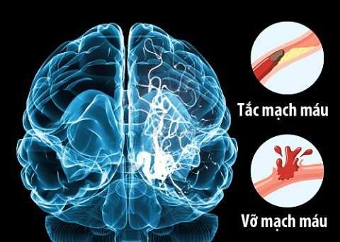 1, Nguyên nhân gây đột quỵ não 1