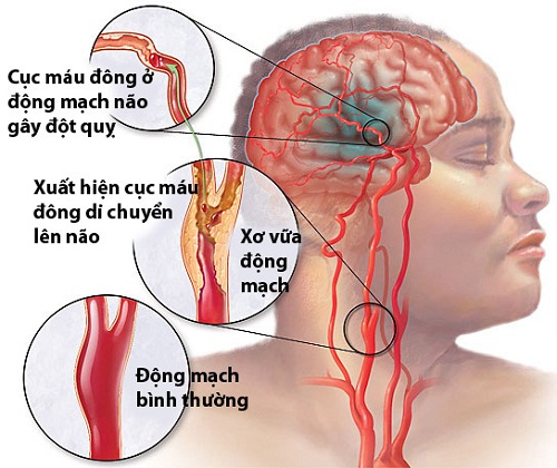 Dấu hiệu nhận biết bệnh đột quỵ não 1