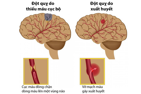 Nguyên nhân mắc bệnh đột quỵ não & yếu tố gây nguy cơ cao