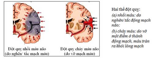 Đột quỵ não có mấy loại? 1