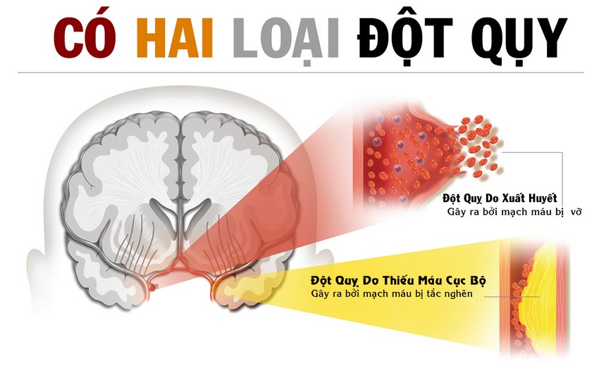 Đột quỵ não: Những điều cần biết để xử trí đúng & kịp thời 1