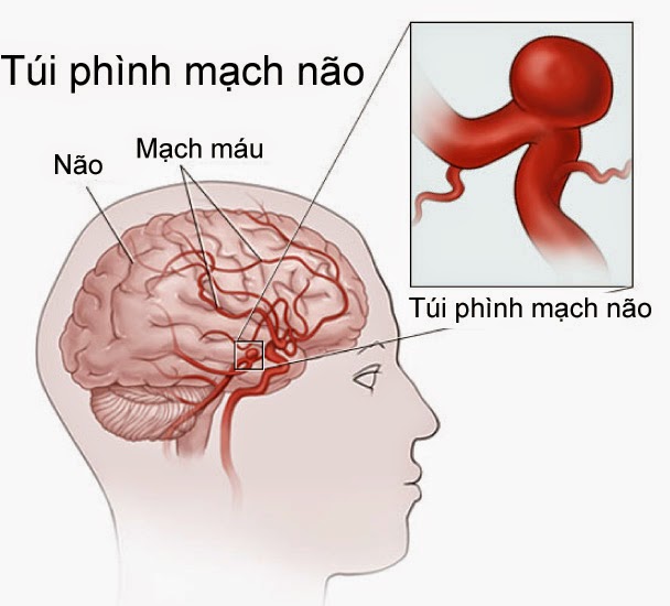 5 nguyên nhân gây vỡ mạch máu não 1