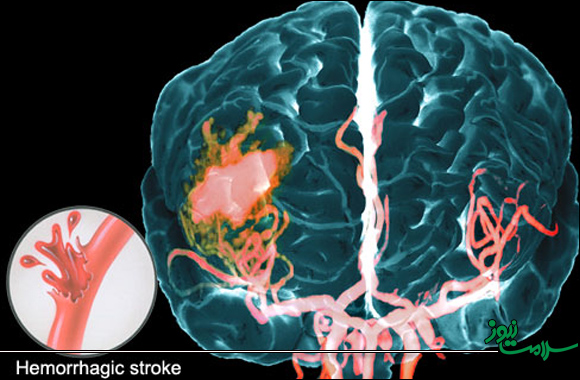 Vỡ mạch máu não: Triệu chứng và cách điều trị 1