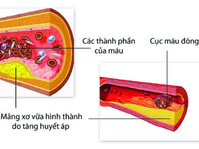 5 Nguyên nhân hàng đầu gây tai biến mạch máu não