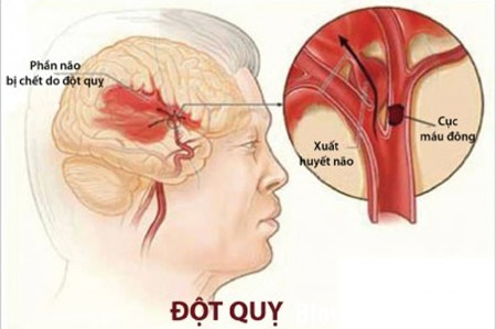 Bệnh học đột quỵ não 1