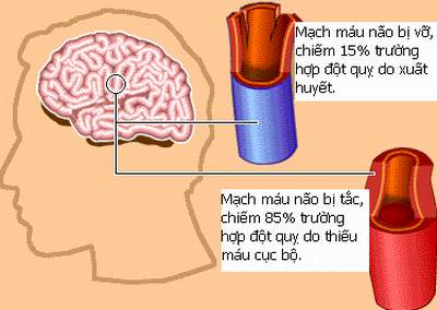 Các loại thuốc điều trị đột quỵ não