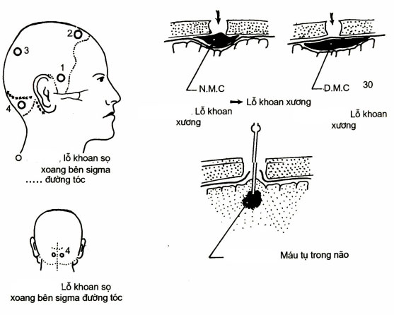 Chấn thương sọ não kín 1