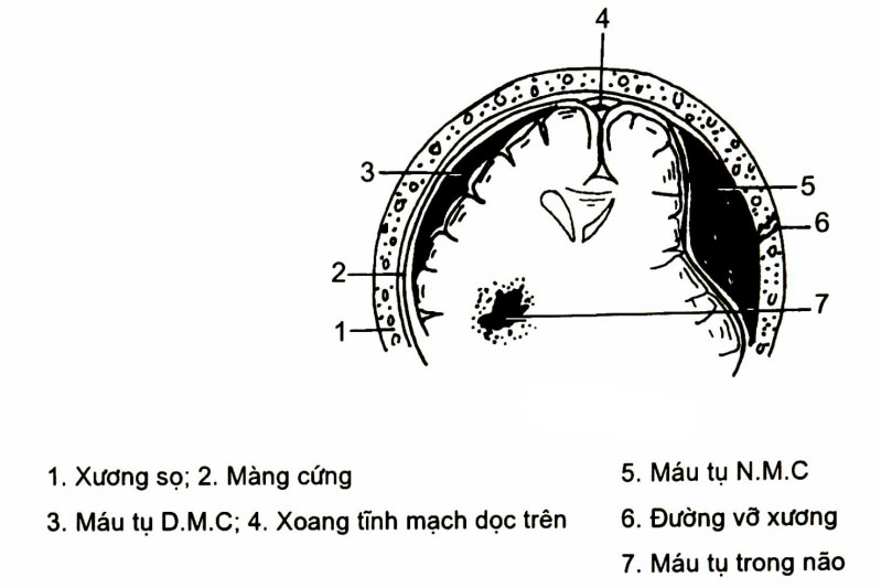 Máu tụ 1