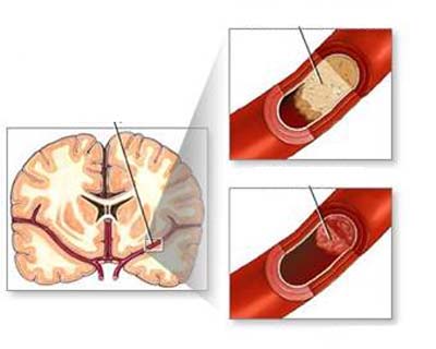 Nguyên nhân nào dẫn đến bệnh sa sút trí tuệ mạch máu 1