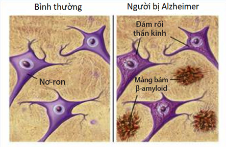 Bài thuốc quý cho người lú lẫn, sa sút trí nhớ 1