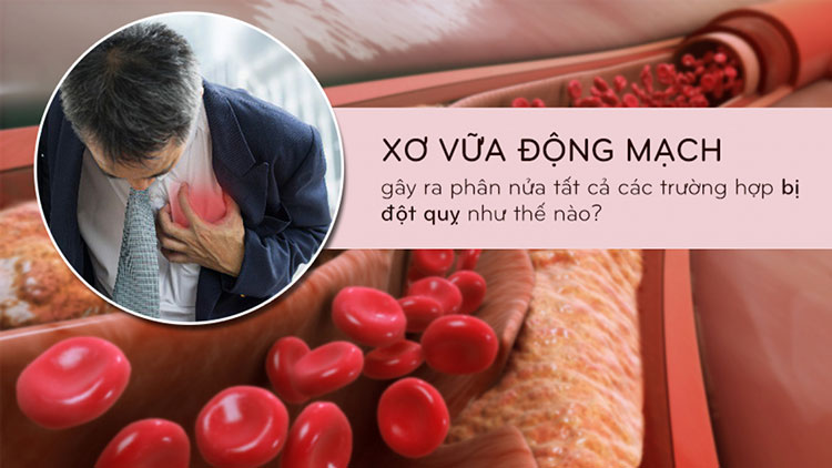 Mối quan hệ nguy hiểm giữa bệnh xơ vữa động mạch và đột quỵ