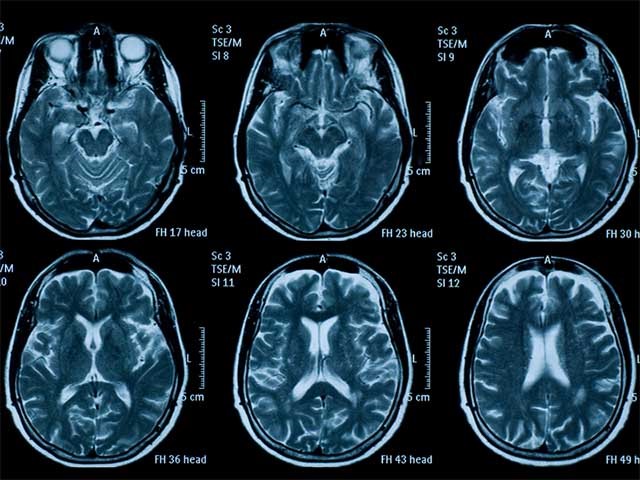 Ảnh chụp CT bệnh thoái hoá tiểu não