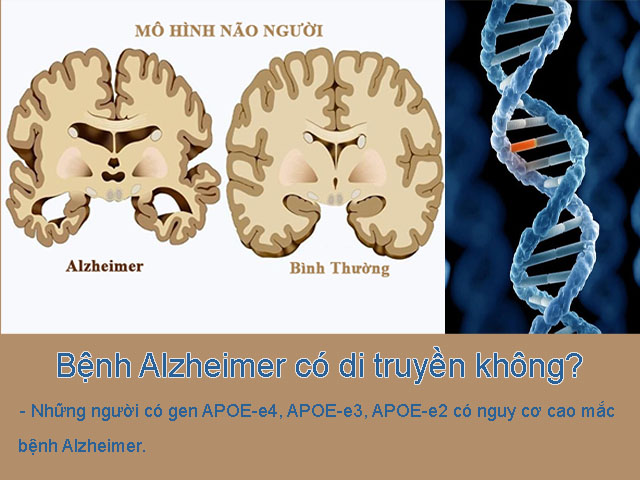 Bệnh Alzheimer có di truyền không