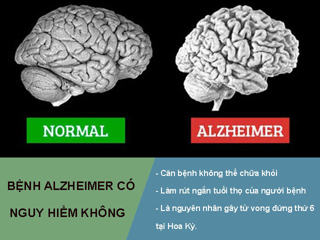 Bệnh Alzheimer có nguy hiểm không