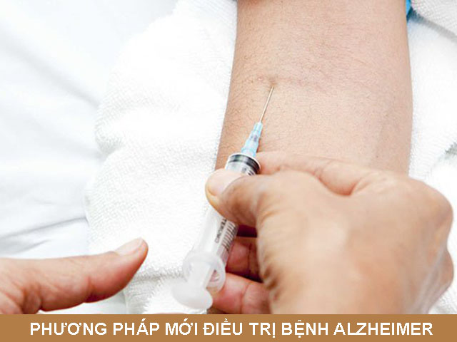 Phương pháp mới điều trị bệnh alzheimer