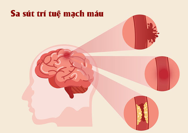 Sa sút trí tuệ do mạch máu - Nguyên nhân và cách điều trị